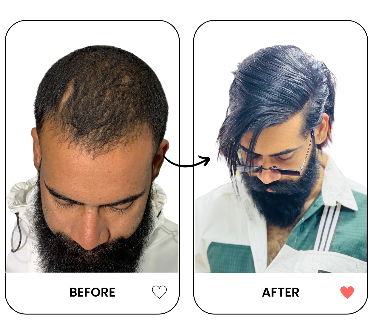 hair-transplant